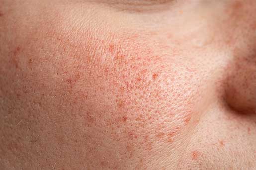 Skin Problem - Open Skin Pores
