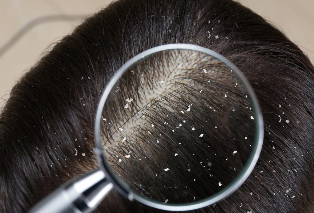 Dandruff, vata aggravated stage