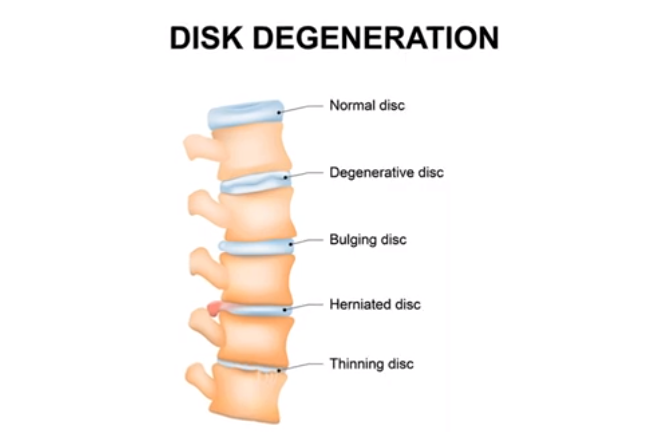 Causes of lower back pain